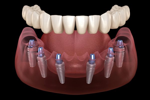 614c8cdc4ea2610312fccf68_611f6df10f1e6b2540bab56d_611e66d0defe1a0f54599723_implant-dentures-3